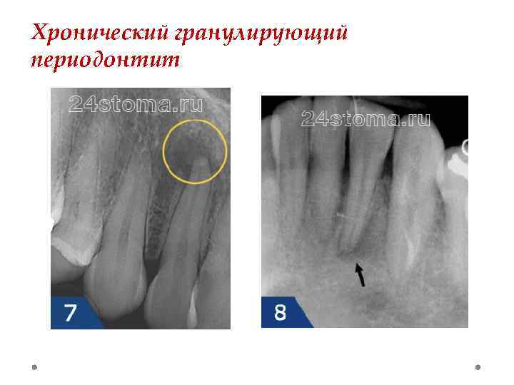 Хронический гранулирующий периодонтит 