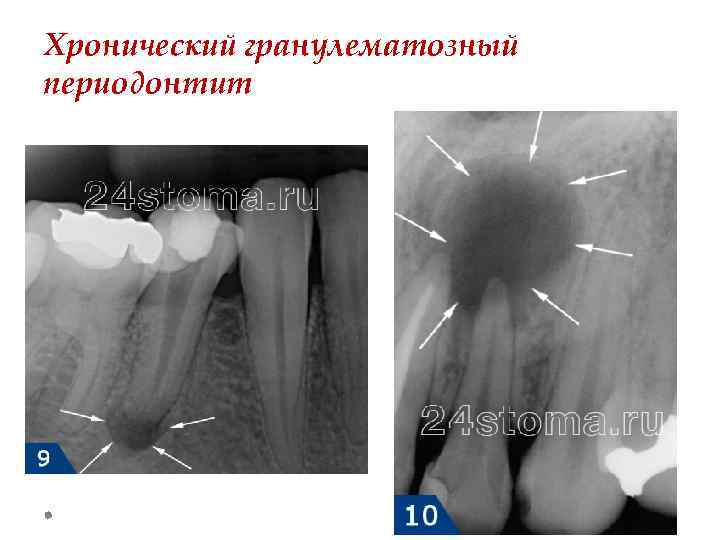 Хронический гранулирующий периодонтит план лечения