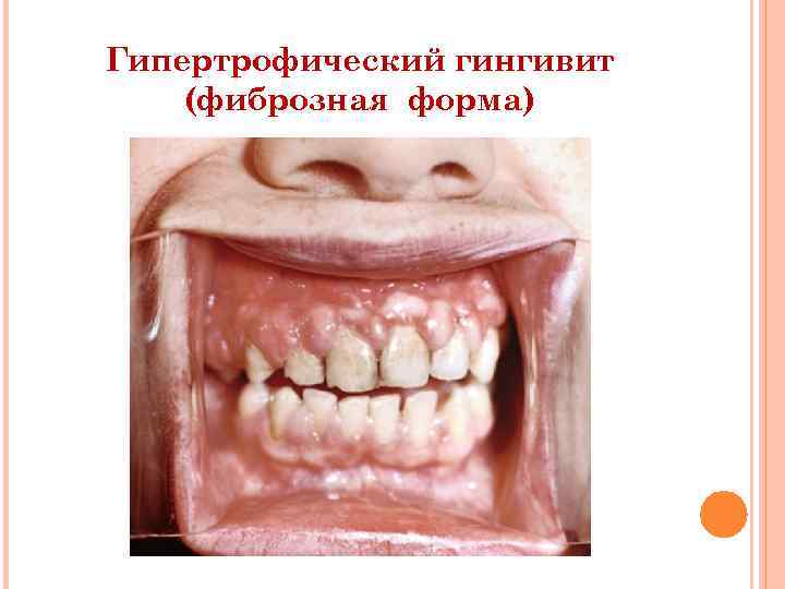 Гипертрофический гингивит (фиброзная форма) 