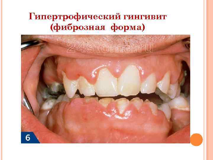 Гипертрофический гингивит (фиброзная форма) 