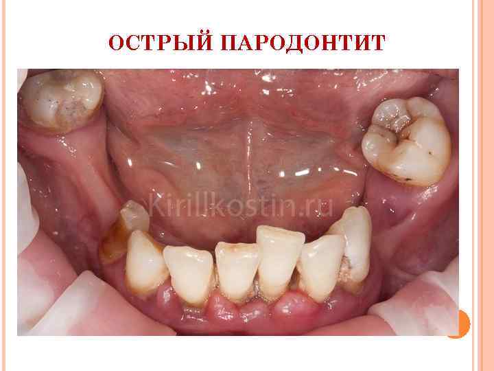 ОСТРЫЙ ПАРОДОНТИТ 