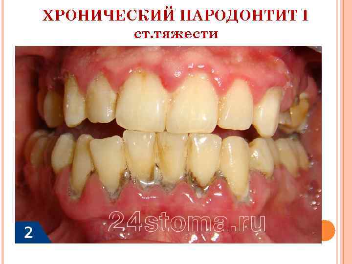 ХРОНИЧЕСКИЙ ПАРОДОНТИТ I ст. тяжести 