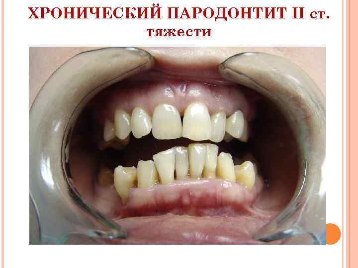 ХРОНИЧЕСКИЙ ПАРОДОНТИТ II ст. тяжести 