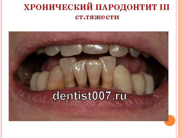ХРОНИЧЕСКИЙ ПАРОДОНТИТ III ст. тяжести 