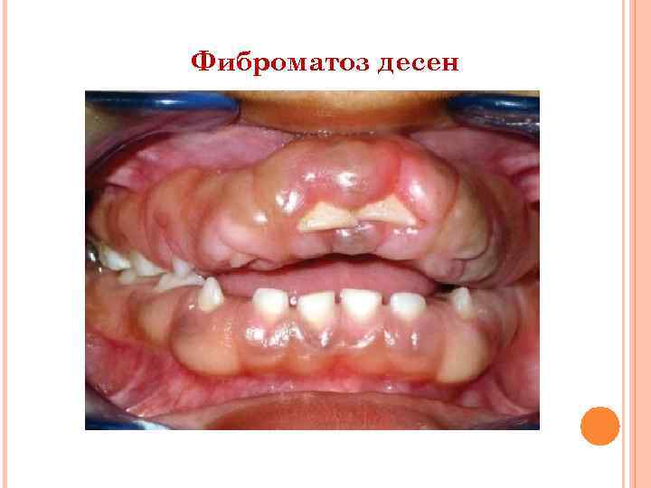 Фиброматоз десен 