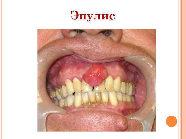 Эпулис 