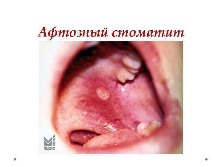 Афтозный стоматит 