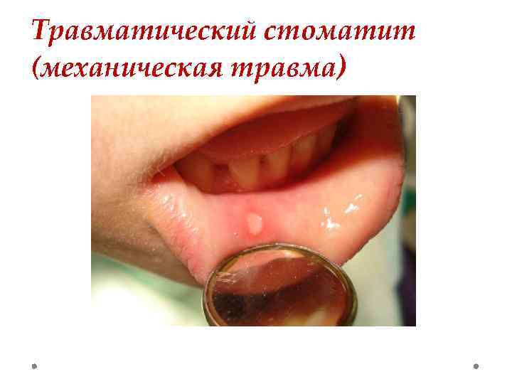 Травматический стоматит (механическая травма) 