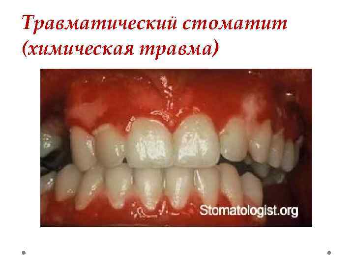 Травматический стоматит (химическая травма) 