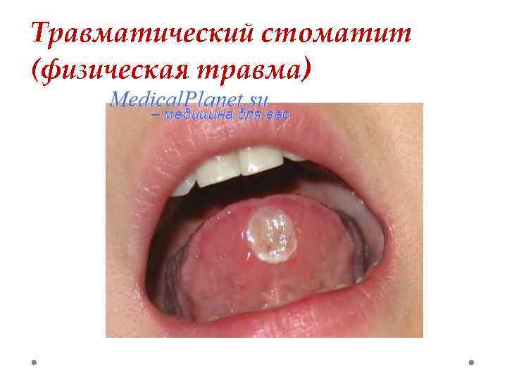Травматический стоматит (физическая травма) 
