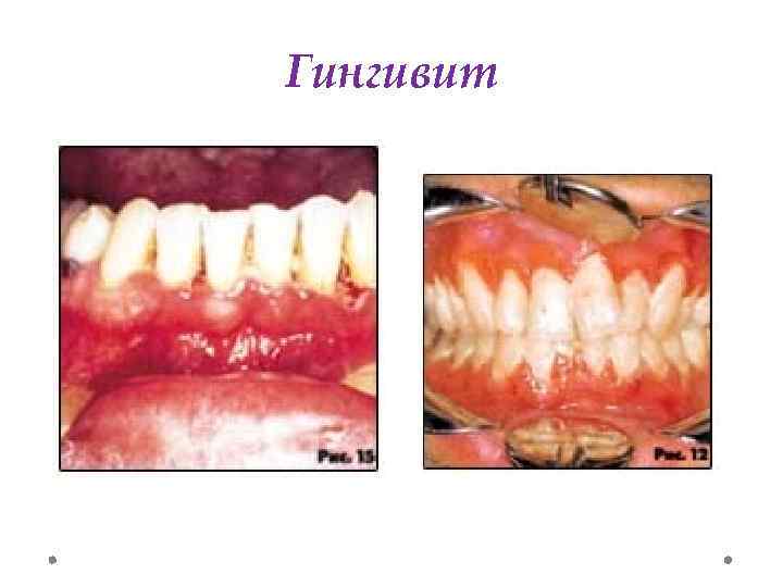Гингивит 