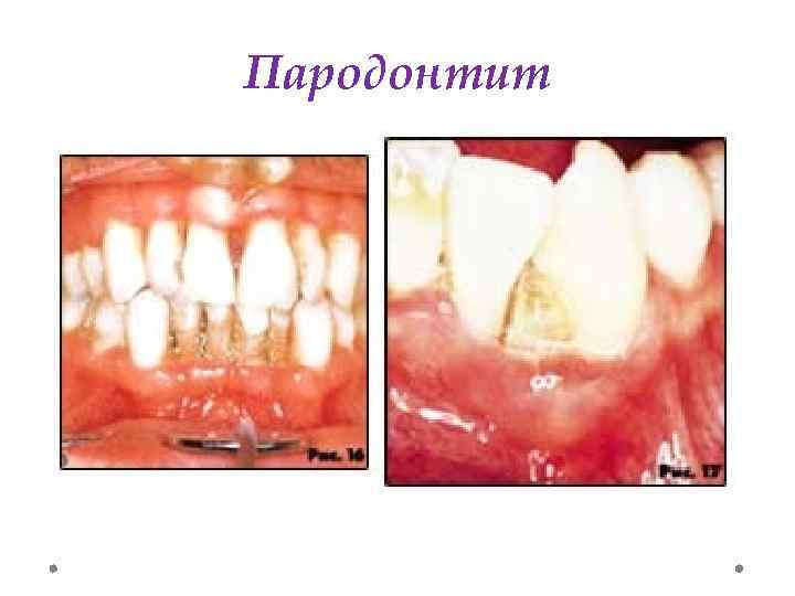 Пародонтит 