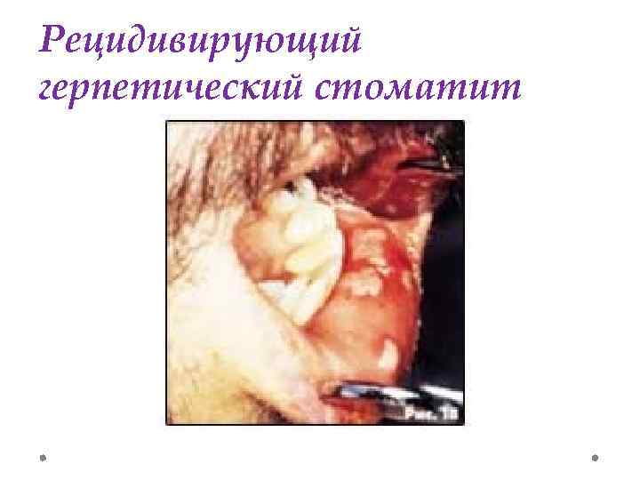Рецидивирующий герпетический стоматит 