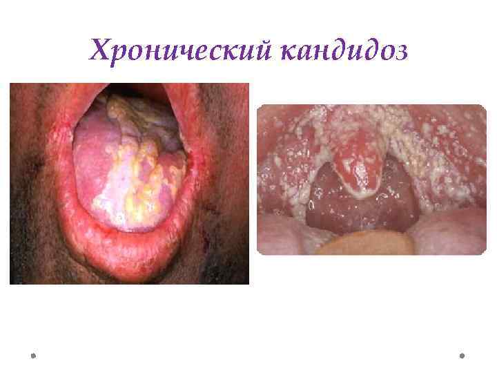 Хронический кандидоз 