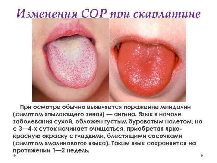Изменения СОР при скарлатине При осмотре обычно выявляется поражение миндалин (симптом «пылающего зева» )