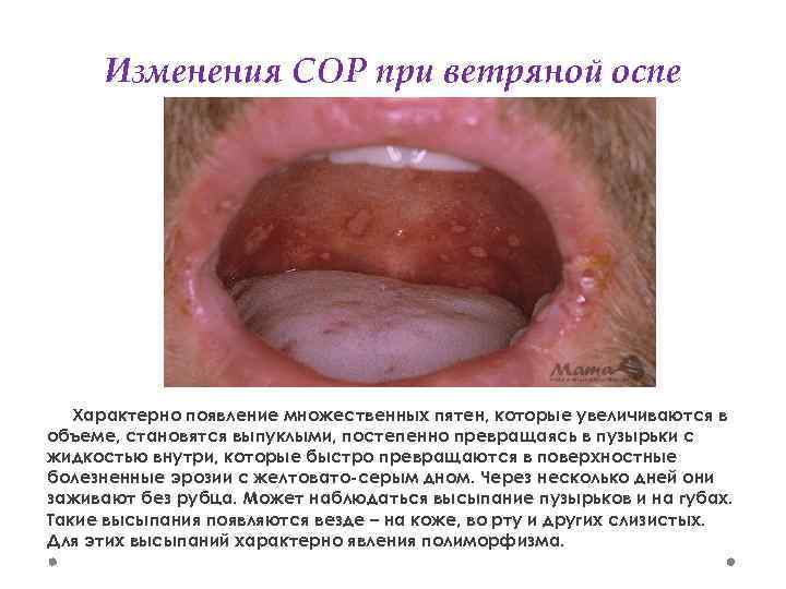 Изменения СОР при ветряной оспе Характерно появление множественных пятен, которые увеличиваются в объеме, становятся