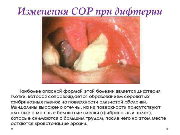 Изменения СОР при дифтерии Наиболее опасной формой этой болезни является дифтерия глотки, которая сопровождается