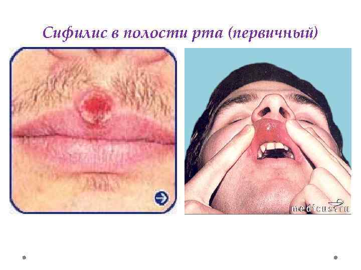 Сифилис в полости рта (первичный) 