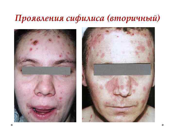Проявления сифилиса (вторичный) 