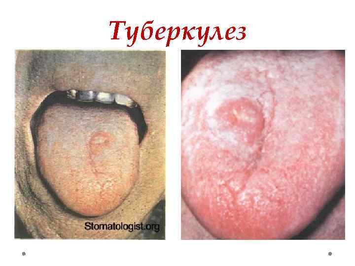 Туберкулез 