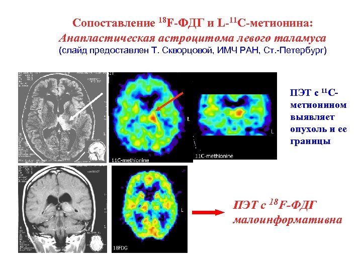 Сопоставление 18 F-ФДГ и L-11 C-метионина: Анапластическая астроцитома левого таламуса (слайд предоставлен Т. Скворцовой,