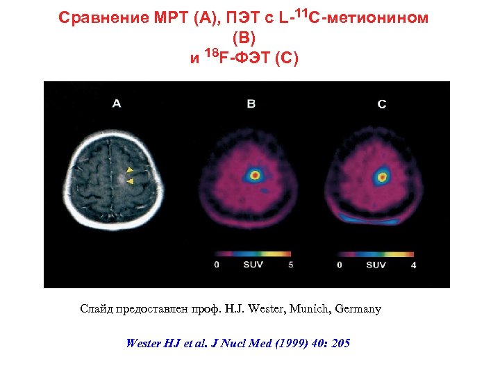 Сравнение МРТ (А), ПЭТ с L-11 C-метионином (В) и 18 F-ФЭТ (С) Слайд предоставлен