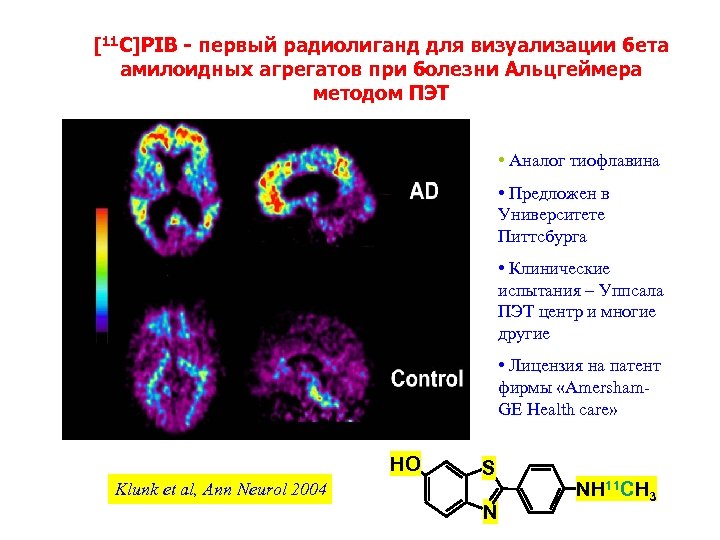 [11 C]PIB - первый радиолиганд для визуализации бета амилоидных aгрегaтoв при болезни Альцгеймера методом