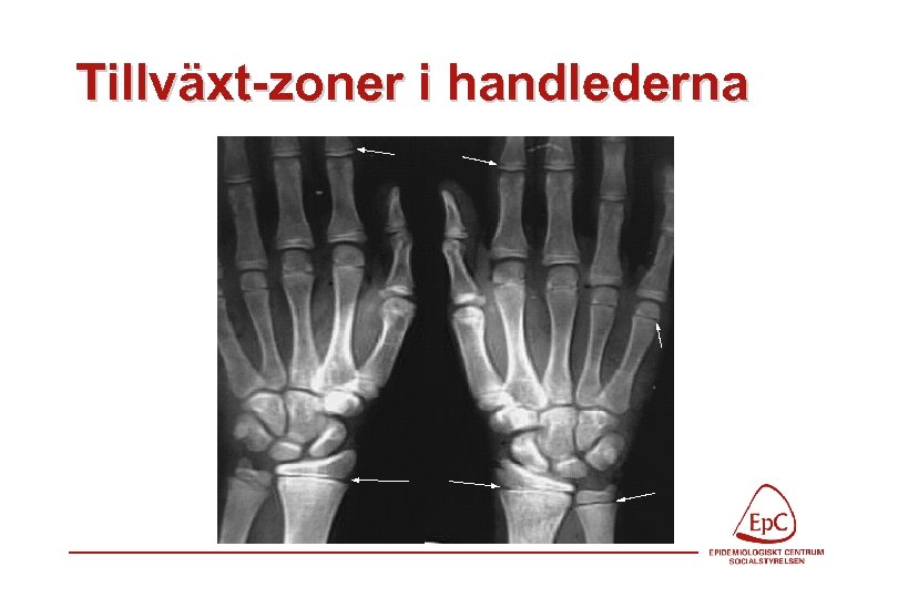 Tillväxt-zoner i handlederna 