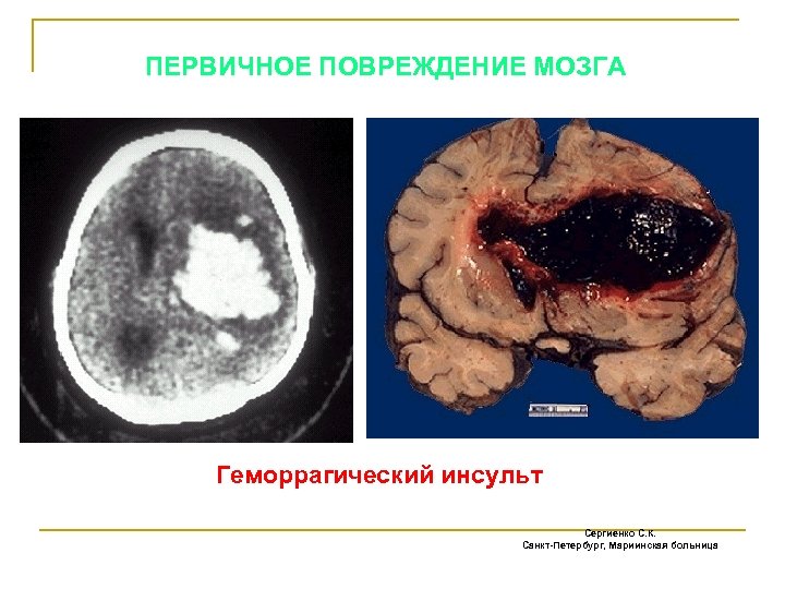 ПЕРВИЧНОЕ ПОВРЕЖДЕНИЕ МОЗГА Геморрагический инсульт Сергиенко С. К. Санкт-Петербург, Мариинская больница 