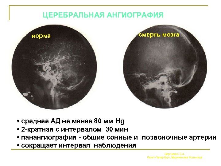 ЦЕРЕБРАЛЬНАЯ АНГИОГРАФИЯ норма смерть мозга • среднее АД не менее 80 мм Hg •