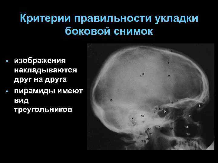 Критерии правильности укладки боковой снимок § § изображения накладываются друг на друга пирамиды имеют