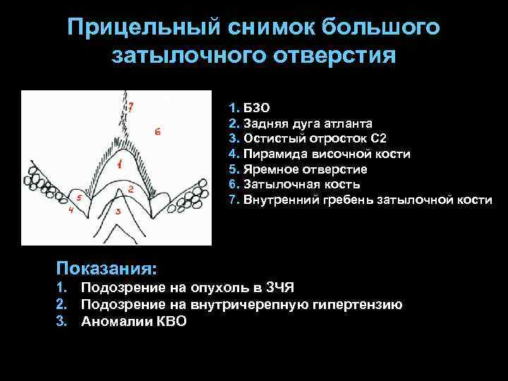 Прицельный снимок большого затылочного отверстия 1. БЗО 2. Задняя дуга атланта 3. Остистый отросток