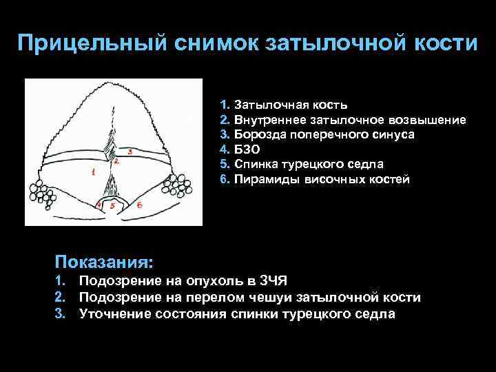 Прицельный снимок затылочной кости 1. Затылочная кость 2. Внутреннее затылочное возвышение 3. Борозда поперечного
