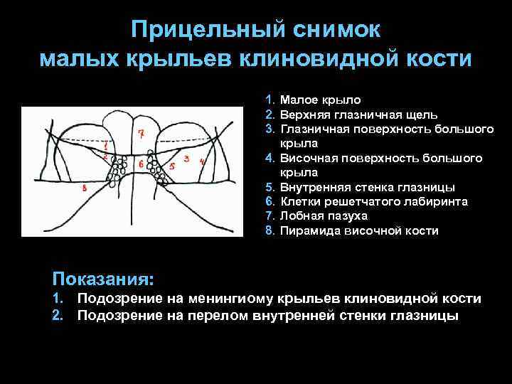 Прицельный снимок малых крыльев клиновидной кости 1. Малое крыло 2. Верхняя глазничная щель 3.