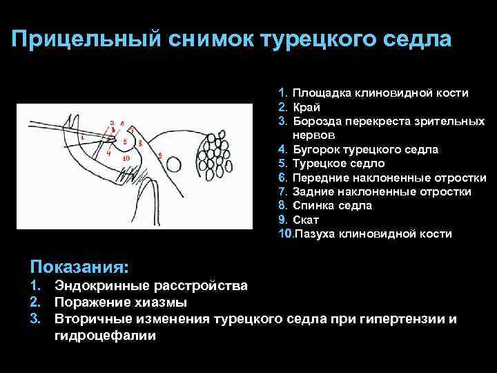 Прицельный снимок турецкого седла 1. Площадка клиновидной кости 2. Край 3. Борозда перекреста зрительных