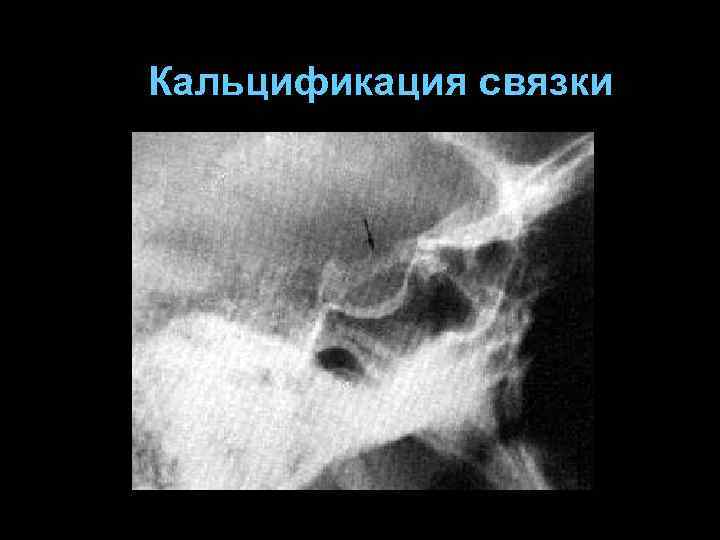 Кальцификация связки 
