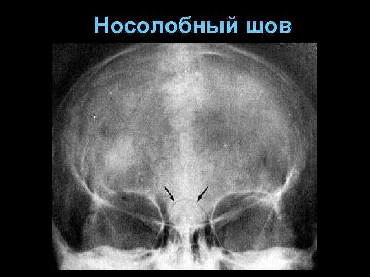 Носолобный шов 