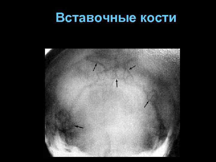 Вставочные кости 