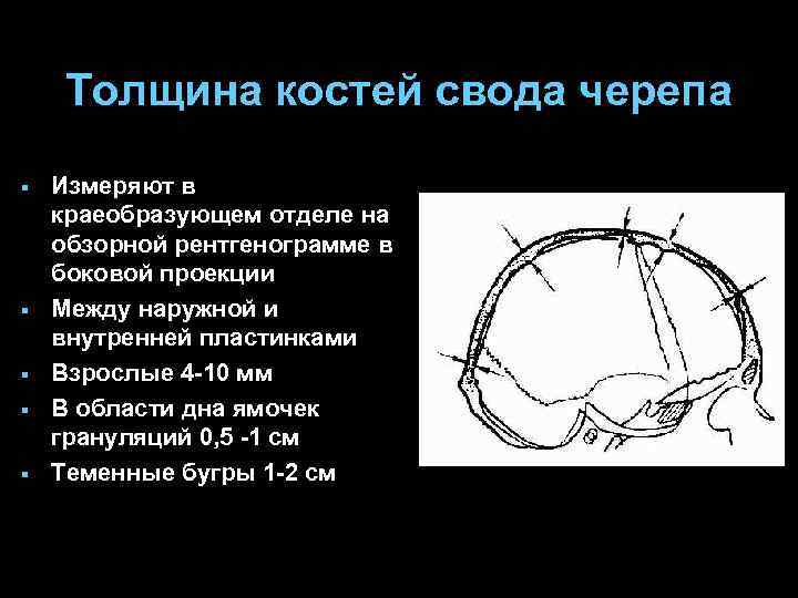 Толщина костей свода черепа § § § Измеряют в краеобразующем отделе на обзорной рентгенограмме