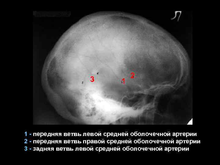3 1 2 1 - передняя ветвь левой средней оболочечной артерии 2 - передняя