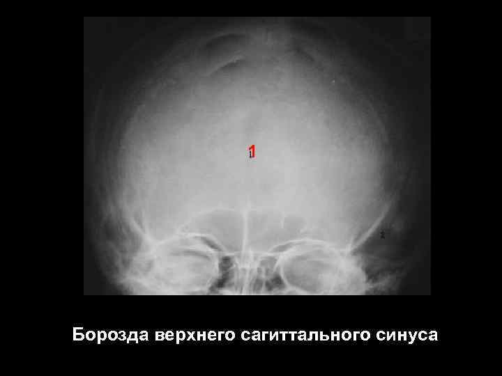 1 Борозда верхнего сагиттального синуса 