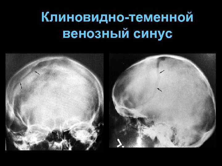 Клиновидно-теменной венозный синус 