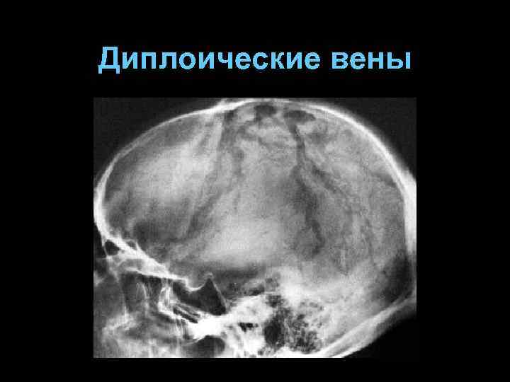 Диплоические вены 