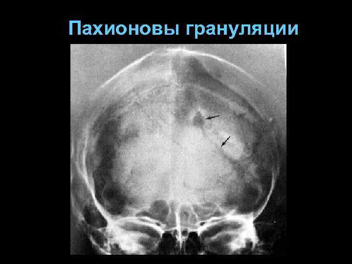 Пахионовы грануляции 