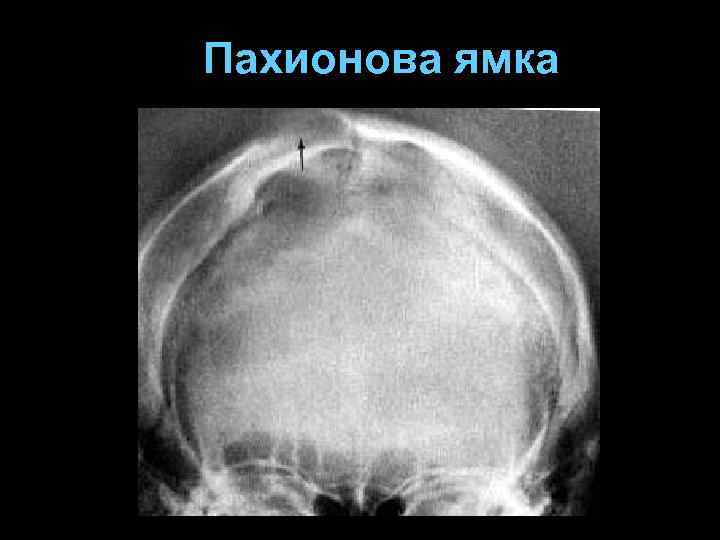 Пахионова ямка 