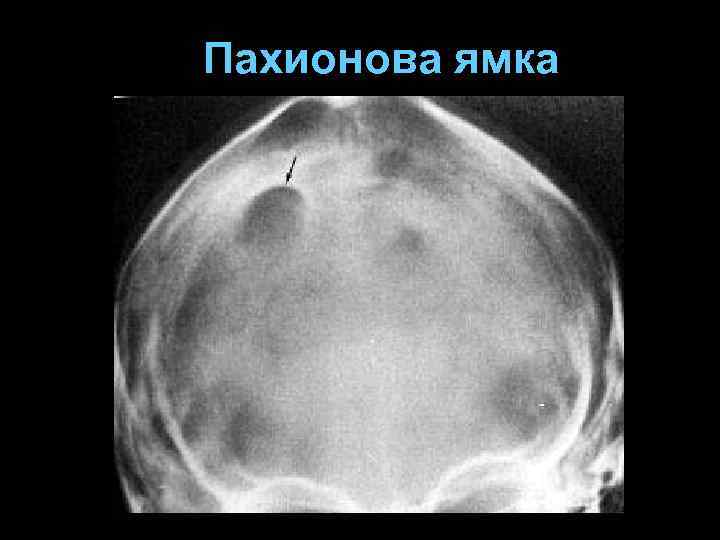 Пахионова ямка 