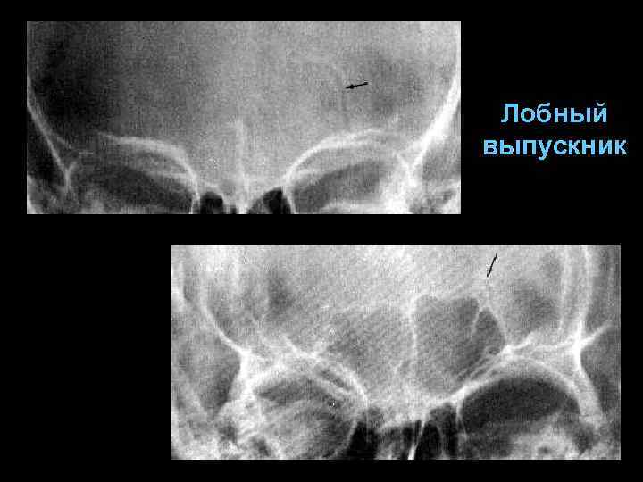 Лобный выпускник 