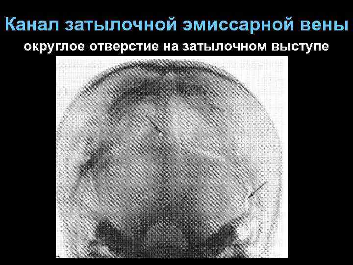 Канал затылочной эмиссарной вены округлое отверстие на затылочном выступе 