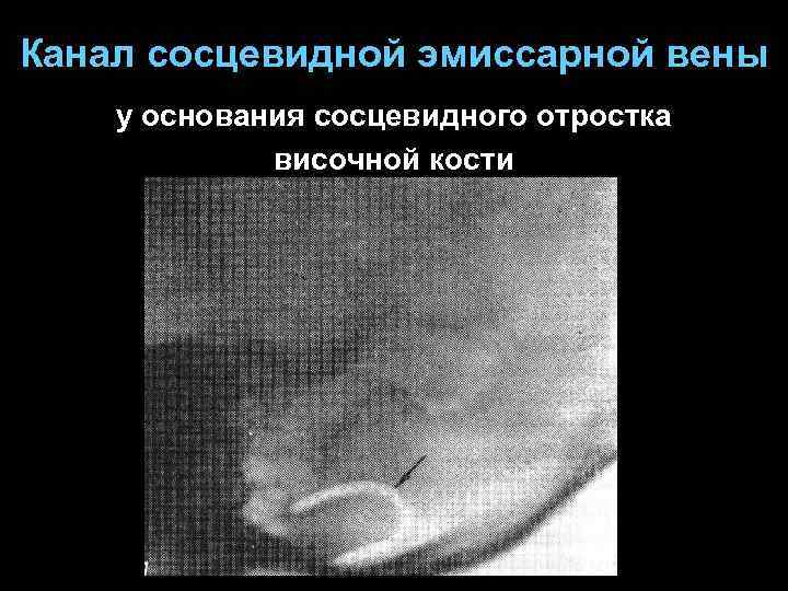 Канал сосцевидной эмиссарной вены у основания сосцевидного отростка височной кости 