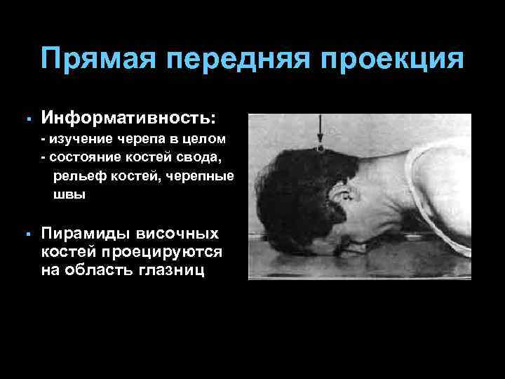 Прямая передняя проекция § Информативность: - изучение черепа в целом - состояние костей свода,